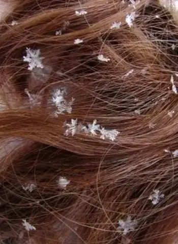 Снежинки на волосах